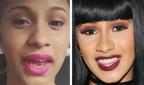 cardi b teeth before surgery|cardi b before and after pictures.